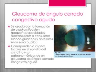 Glaucoma de ángulo cerrado
congestivo agudo
 Se asocia con la formación
de glaukomfleckten
(pequeñas opacidades
subcapsulares o capsulares
blanco-grisáceas y anteriores
en la zona pupilar)
 Corresponden a infartos
focales en el epitelio del
cristalino y son
patognomónicos de un
glaucoma de ángulo cerrado
congestivo agudo
 