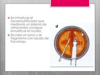  Se introduce el
facoemulsificador que
mediante un sistema de
ultrasonidos consigue
emulsificar el núcleo.
 Se crea un surco y se
fragmenta con ayuda de
Facoshop.
 