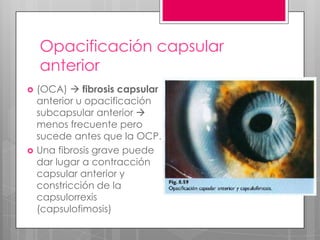 Opacificación capsular
anterior
 (OCA)  fibrosis capsular
anterior u opacificación
subcapsular anterior 
menos frecuente pero
sucede antes que la OCP.
 Una fibrosis grave puede
dar lugar a contracción
capsular anterior y
constricción de la
capsulorrexis
(capsulofimosis)
 