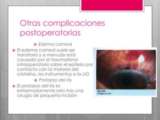 Otras complicaciones
postoperatorias
 Edema corneal
 El edema corneal suele ser
transitorio y a menudo está
causado por el traumatismo
intraoperatorio sobre el epitelio por
contacto con la materia del
cristalino, los instrumentos o la LIO
 Prolapso del iris
 El prolapso del iris es
extremadamente raro tras una
cirugía de pequeña incisión
 
