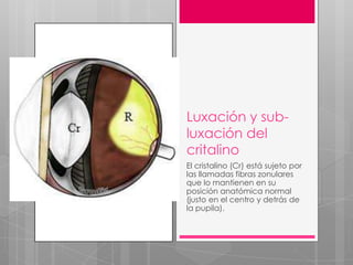 Luxación y sub-
luxación del
critalino
El cristalino (Cr) está sujeto por
las llamadas fibras zonulares
que lo mantienen en su
posición anatómica normal
(justo en el centro y detrás de
la pupila).
 