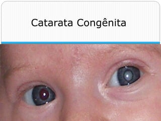 Catarata Congênita
 