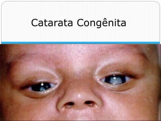 Catarata Congênita
 