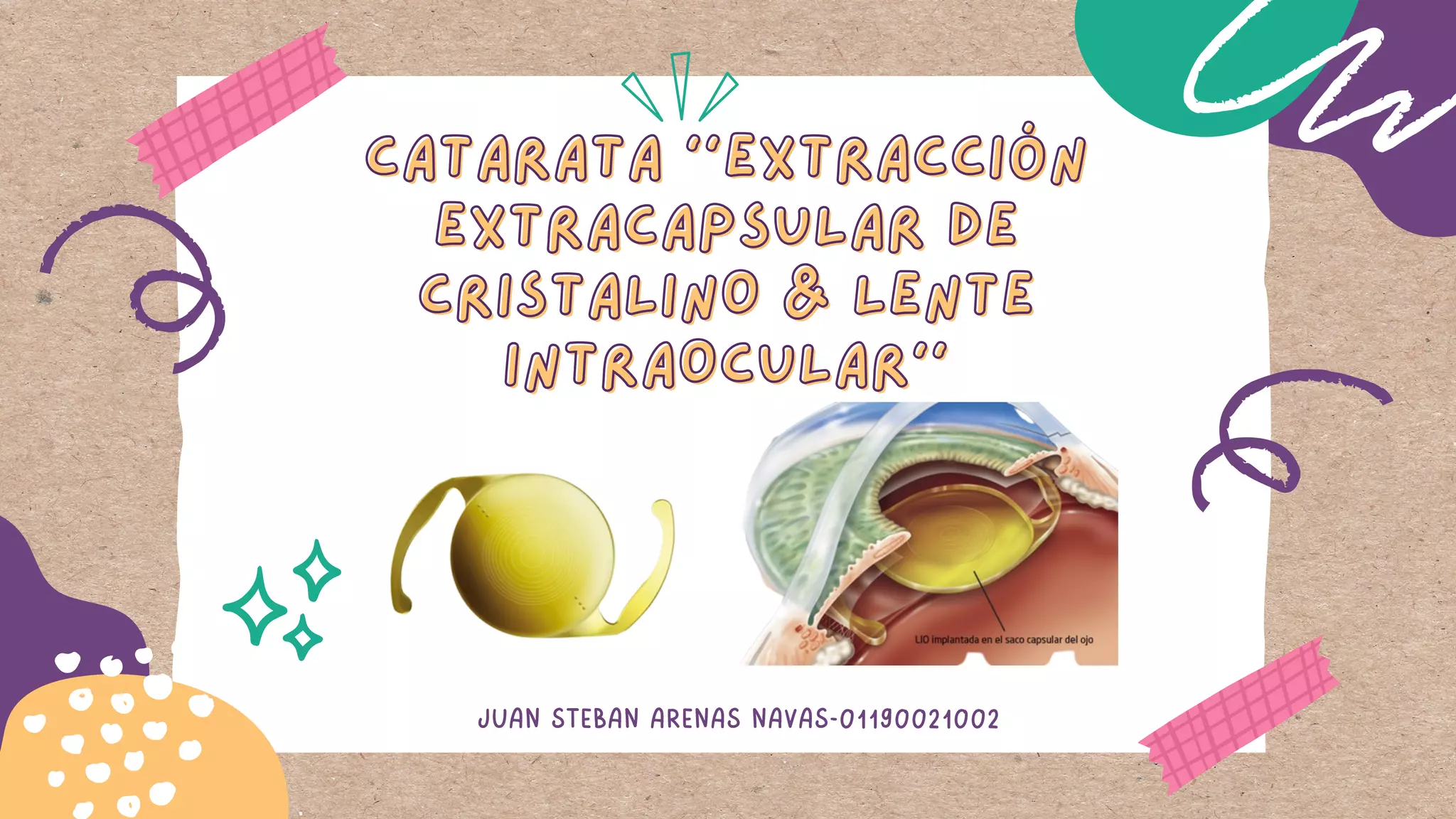 catarata extraccion extracapsular..pdf