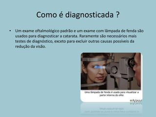 Como é diagnosticada ?
• Um exame oftalmológico padrão e um exame com lâmpada de fenda são
usados para diagnosticar a catarata. Raramente são necessários mais
testes de diagnóstico, exceto para excluir outras causas possíveis da
redução da visão.
 