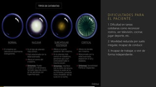 D I F I C U LTA D E S PA R A
E L PAC I E N T E .
1. Dificultad en tareas
cotidianas como reconocer
rostros, ver televisión, cocinar,
jugar deporte, etc.
2. Movilidad reducida por suelo
irregular, incapaz de conducir.
3. Incapaz de trabajar, o vivir de
forma independiente.
 