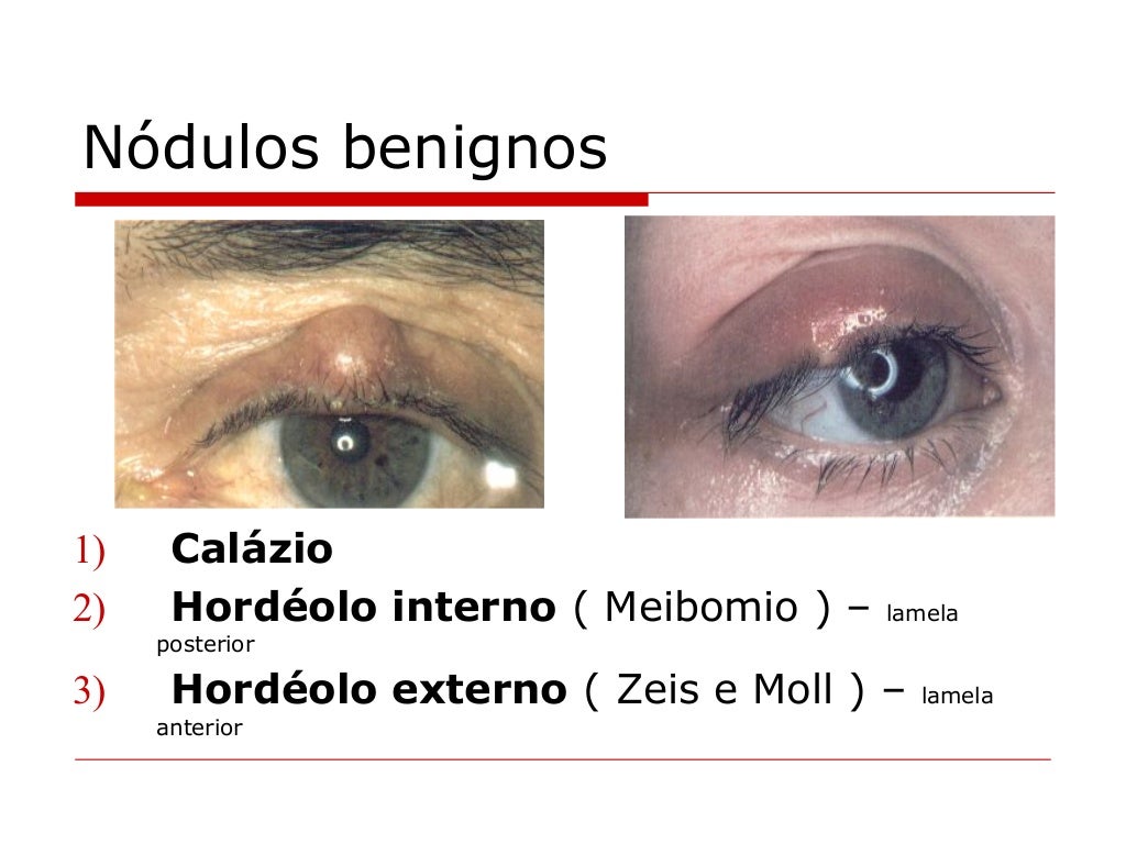 Cataratas doenças das pálpebras