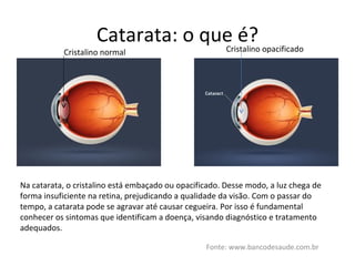 Catarata: o que é? Fonte: www.bancodesaude.com.br Cristalino normal Cristalino opacificado Na catarata, o cristalino está embaçado ou opacificado. Desse modo, a luz chega de forma insuficiente na retina, prejudicando a qualidade da visão. Com o passar do tempo, a catarata pode se agravar até causar cegueira. Por isso é fundamental conhecer os sintomas que identificam a doença, visando diagnóstico e tratamento adequados. 