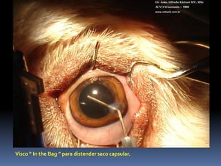 Dioptrix PFI 12 SEDr. João Alfredo Kleiner MV, MScACVO Wisconsin – 1998www.vetweb.com.brPara sacos capsulares pequenos (Pequeno e Médio Porte)Incisão de 2,85 a 3,2 mmPeça única26% acrílico hidrofílicoFiltro UVDiâmetro total: 12 mmDiâmetro óptico: 6 mmBordas anguladasAngulação de alça de 100+41 D de poder refrativoEsterilizado em autoclave.