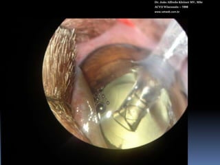 Medicontur SVETDr. João Alfredo Kleiner MV, MScACVO Wisconsin – 1998www.vetweb.com.brPara sacos capsulares pequenos  Incisão de 3,2 mmPeça única e asféricaCopolímero hidrofílico - hidrofóbicoFiltro UV, azul e amarelo.Diâmetro total: 12 mmDiâmetro óptico: 6,5 mmBordas anguladas4 alças Angulação de alça de 50+41 D de poder refrativoEsterilizado à vapor.