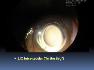 Medicontur XVETDr. João Alfredo Kleiner MV, MScACVO Wisconsin – 1998www.vetweb.com.brPara sacos capsulares grandes  Incisão de 3,2 mmPeça única e asféricaCopolímero hidrofílico - hidrofóbicoFiltro UV, azul e amarelo.Diâmetro total: 14 mmDiâmetro óptico: 6,5 mmBordas anguladasTipo plate Angulação de alça de 50+41 D de poder refrativoEsterilizado à vapor.