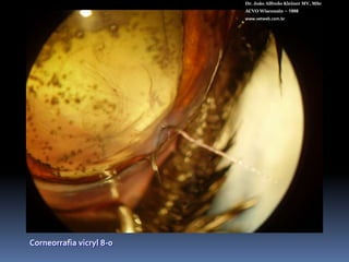 AcriVet(Germany)Dr. João Alfredo Kleiner MV, MScACVO Wisconsin – 1998www.vetweb.com.brPara sacos capsulares cães, felinos e equinos. Incisão de 3,2 mmPeça única25% de água e acrílico hidrofílicoFiltro UVAbertura lentaDiâmetro total: 12 / 13 / 14 mm (cães e gatos)21 / 22 mm (equinos)Diâmetro óptico: 7 mmBordas anguladasAngulação de alça de 00+41 D (cães)+ 53,5 D (felinos)+ 14 D e + 21 D (equinos) Esterilizado em autoclave.