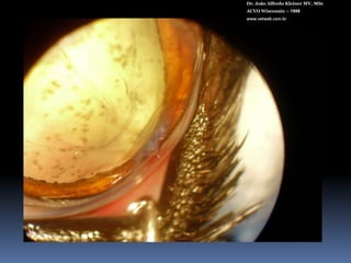 Dr. João Alfredo Kleiner MV, MScACVO Wisconsin – 1998www.vetweb.com.brAnéis melhoram a difração (foco) dos raios luminosos e permitem uma espessura menor da LIOEspessura: 1,01 mmLIO normal 2,4 mm