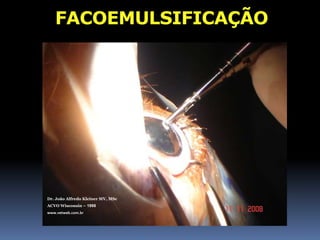 Dr. João Alfredo Kleiner MV, MScACVO Wisconsin – 1998www.vetweb.com.brINTRACAPSULARRisco:Luxações lenticularesPerda vítreoDescolamento retinaAderência fibras colágeno vítreo 		   cápsula posterior + fortes que no humano