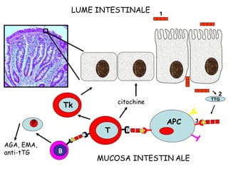 LUME INTESTINALE MUCOSA INTESTIN   ALE T citochine TTG 1 2 3 B AGA, EMA, anti-tTG Tk P APC 