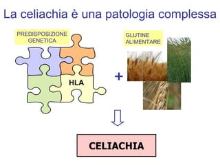 La celiachia è una patologia complessa +   CELIACHIA HLA PREDISPOSIZIONE GENETICA GLUTINE ALIMENTARE 