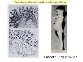 Lancet 1957;ii:876-877 The first celiac child diagnosed by small intestinal biopsy 