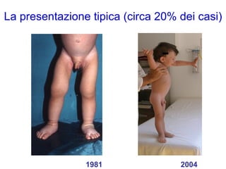 La presentazione tipica (circa 20% dei casi)   1981 2004 