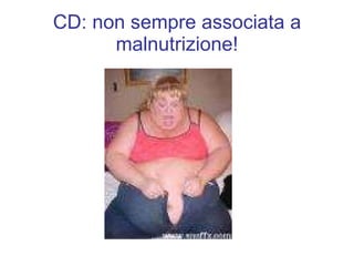 CD: non sempre associata a malnutrizione! 