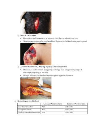2) Strecth Laceration
 Disebabkan oleh tarikan atau peregangan kulit disertai tekanan yang kuat
 Misalnya peregangan paha yang berlebihan dapat menyebabkan laserai pada inguinal
3) Avulsion Laceration / Flaying Injury / Grind Laceration
 Disebabkan oleh kompresi penggilingan sehingga kulit terlepas dari jaringan di
bawahnya (degloving of the skin)
 Hampir selalu melibatkan benda yang berputar seperti roda motor
c. Kepentingan Medikolegal
Laserasi Antemortem Laserasi Postmortem
Ekstravasasidarah Ada Tidak ada
Koagulasi darah Ada Tidak ada
Peningkatan aktivitas enzim Ada Tidak ada
 