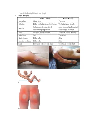  Asfiksia karena inhalasi uap panas
d. Hasil Autopsi
Luka Lepuh Luka Bakar
Penyebab Moist heat Dry heat
Pakaian Tidak berbakar, mungkin basah Terbakar atau meleleh
Lokasi
Luka muncul pada dan di
bawah tempat paparan
Luka muncul pada dan di
atas tempat paparan
Kulit Eritema, bullae, basah Eritema, bullae, kering
Splashing Ada Tidak ada
Kulit hangus Tidak ada Ada
Rambut terbakar Tidak ada Ada
Scar Tipis dan tidak contracted Tebal dan contracted
 