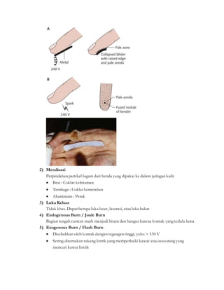 2) Metalisasi
Perpindahan partikel logam dari benda yang dipakai ke dalam jaringan kulit
 Besi : Coklat kehitaman
 Tembaga : Coklat kemerahan
 Aluminium : Perak
3) Luka Keluar
Tidak khas. Dapat berupa luka lecet, laserasi, atau luka bakar
4) Endogenous Burn / Joule Burn
Bagian tengah current mark menjadi hitam dan hangus karena kontak yang terlalu lama
5) Exogenous Burn / Flash Burn
 Disebabkan oleh kontak dengan tegangan tinggi, yaitu > 330 V
 Sering ditemukan tukang listrik yang memperbaiki kawat atau seseorang yang
mencuri kawat listrik
 