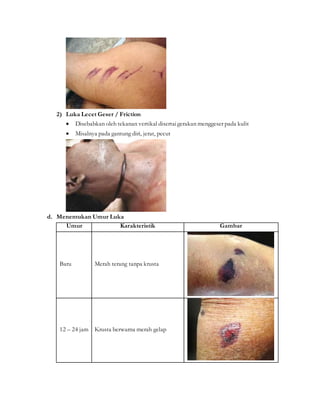 2) Luka Lecet Geser / Friction
 Disebabkan oleh tekanan vertikal disertaigerakan menggeser pada kulit
 Misalnya pada gantung diri, jerat, pecut
d. Menentukan Umur Luka
Umur Karakteristik Gambar
Baru Merah terang tanpa krusta
12 – 24 jam Krusta berwarna merah gelap
 