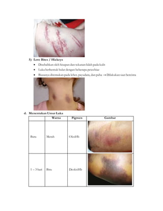 5) Love Bites / Hickeys
 Disebabkan oleh hisapan dan tekanan lidah pada kulit
 Luka berbentuk bulat dengan beberapa petechiae
 Biasanya ditemukan pada leher, payudara, dan paha  Dilakukan saat bercinta
d. Menentukan Umur Luka
Warna Pigmen Gambar
Baru Merah OksiHb
1 – 3 hari Biru DeoksiHb
 
