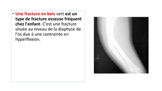 • Une fracture en bois vert est un
type de fracture osseuse fréquent
chez l'enfant. C'est une fracture
située au niveau de la diaphyse de
l'os due à une contrainte en
hyperflexion.
 