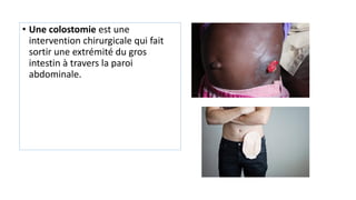 • Une colostomie est une
intervention chirurgicale qui fait
sortir une extrémité du gros
intestin à travers la paroi
abdominale.
 