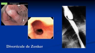 Diverticule de Zenker
 