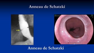 Anneau de Schatzki
Anneau de Schatzki
 