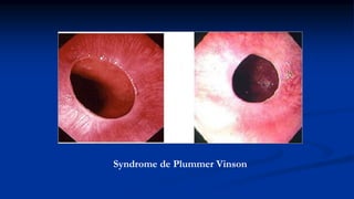 Syndrome de Plummer Vinson
 
