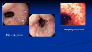 Sténose peptique
Œsophagite radique
 