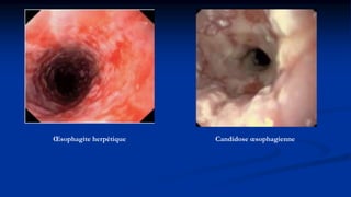 Candidose œsophagienneŒsophagite herpétique
 