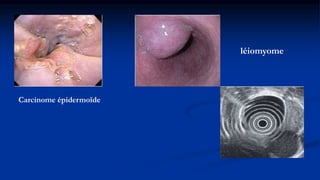 Carcinome épidermoïde
léiomyome
 