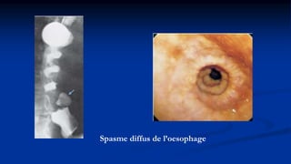 Spasme diffus de l’oesophage
 