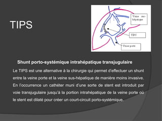 TIPS


  Shunt porto-systémique intrahépatique transjugulaire
Le TIPS est une alternative à la chirurgie qui permet d’effectuer un shunt
entre la veine porte et la veine sus-hépatique de manière moins invasive.
En l’occurrence un cathéter muni d’une sorte de stent est introduit par
voie transjugulaire jusqu’à la portion intrahépatique de la veine porte où
le stent est dilaté pour créer un court-circuit porto-systémique.
 