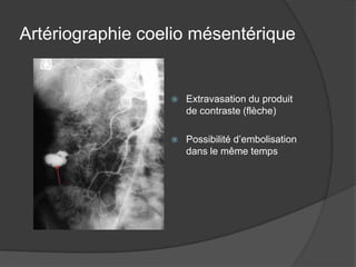 Artériographie coelio mésentérique


                     Extravasation du produit
                      de contraste (flèche)

                     Possibilité d’embolisation
                      dans le même temps
 
