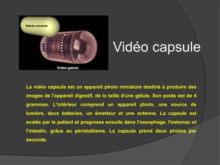 Vidéo capsule

La vidéo capsule est un appareil photo miniature destiné à produire des
images de l'appareil digestif, de la taille d'une gélule. Son poids est de 4
grammes. L'intérieur comprend un appareil photo, une source de
lumière, deux batteries, un émetteur et une antenne. La capsule est
avalée par le patient et progresse ensuite dans l'oesophage, l'estomac et
l'intestin, grâce au péristaltisme. La capsule prend deux photos par
seconde.
 