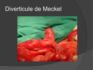 Diverticule de Meckel
 