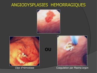 ANGIODYSPLASIES HEMORRAGIQUES




                     OU



 Clips d’hémostase        Coagulation par Plasma argon
 