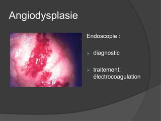 Angiodysplasie
                 Endoscopie :

                    diagnostic

                    traitement:
                     électrocoagulation
 
