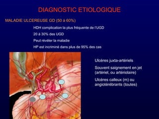DIAGNOSTIC ETIOLOGIQUE
MALADIE ULCEREUSE GD (50 à 60%)
HDH complication la plus fréquente de l’UGD
20 à 30% des UGD
Peut révéler la maladie
HP est incriminé dans plus de 95% des cas
Ulcères juxta-artériels
Souvent saignement en jet
(artériel, ou artériolaire)
Ulcères calleux (m) ou
angiotérébrants (toutes)
 