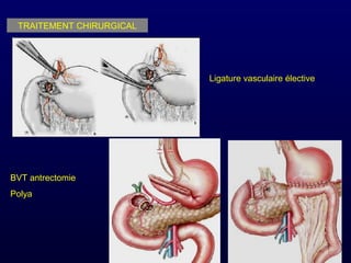 TRAITEMENT CHIRURGICAL
Ligature vasculaire élective
BVT antrectomie
Polya
 