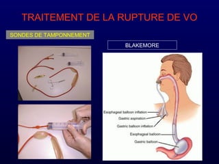 TRAITEMENT DE LA RUPTURE DE VO
SONDES DE TAMPONNEMENT
BLAKEMORE
 