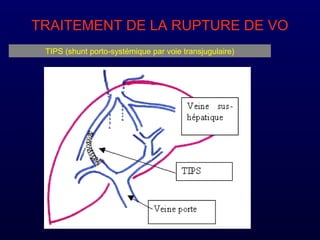 TRAITEMENT DE LA RUPTURE DE VO
TIPS (shunt porto-systémique par voie transjugulaire)
 