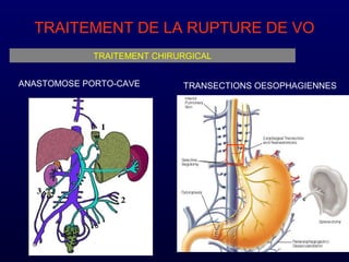 TRAITEMENT DE LA RUPTURE DE VO
TRAITEMENT CHIRURGICAL
TRANSECTIONS OESOPHAGIENNESANASTOMOSE PORTO-CAVE
 
