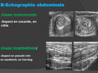 B-Echographie abdominale
Coupe transversale:
-Aspect

en cocarde, en

cible

Coupe longitudinale:
-Aspect en pseudo rein

en sandwich, en hot-dog

 