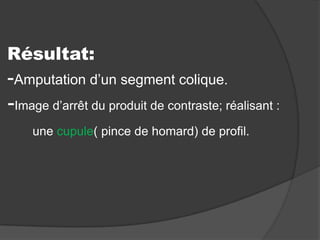 Résultat:

-Amputation d’un segment colique.
-Image d’arrêt du produit de contraste; réalisant :
une cupule( pince de homard) de profil.

 